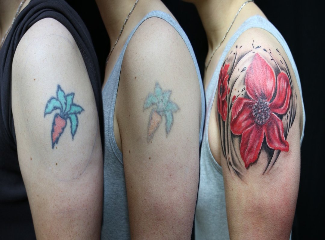 How to Remove a Tattoo Altwayguides